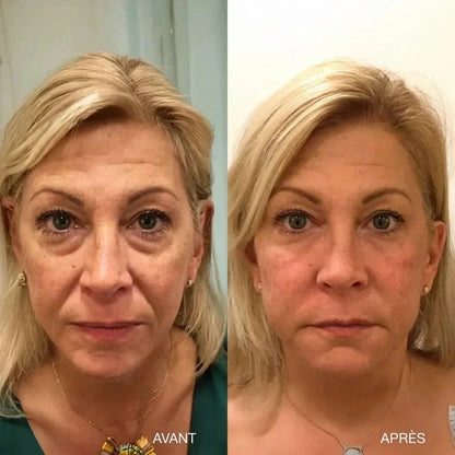Instant V-Lift - Nivalea